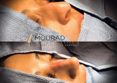 Rhinoplasty Before and After Female