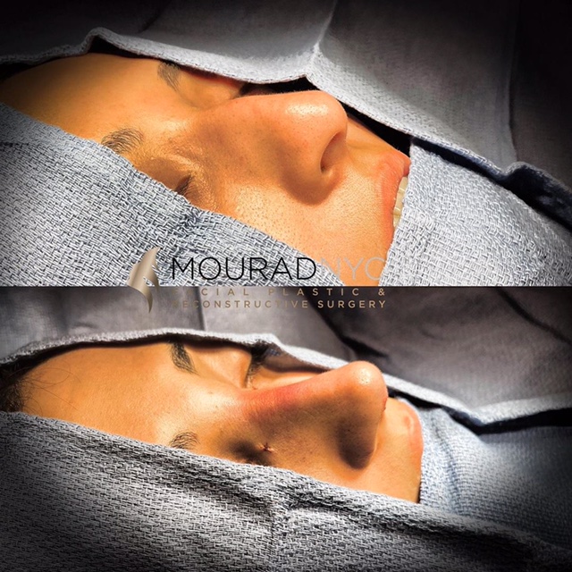 Rhinoplasty Before and After Female Rhinoplasty Before and After Female