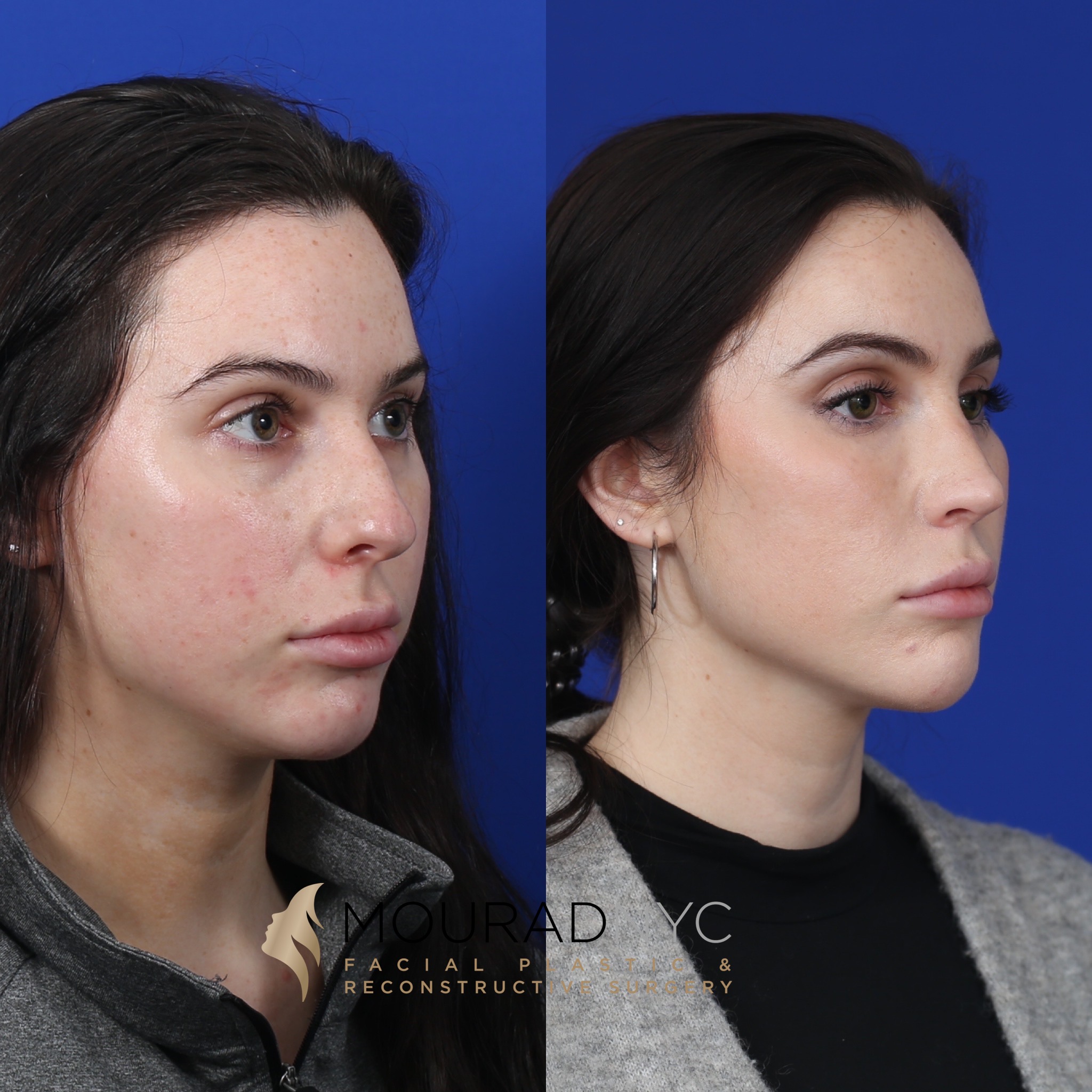 Angle view 2 Before And After Female Rhinoplasty