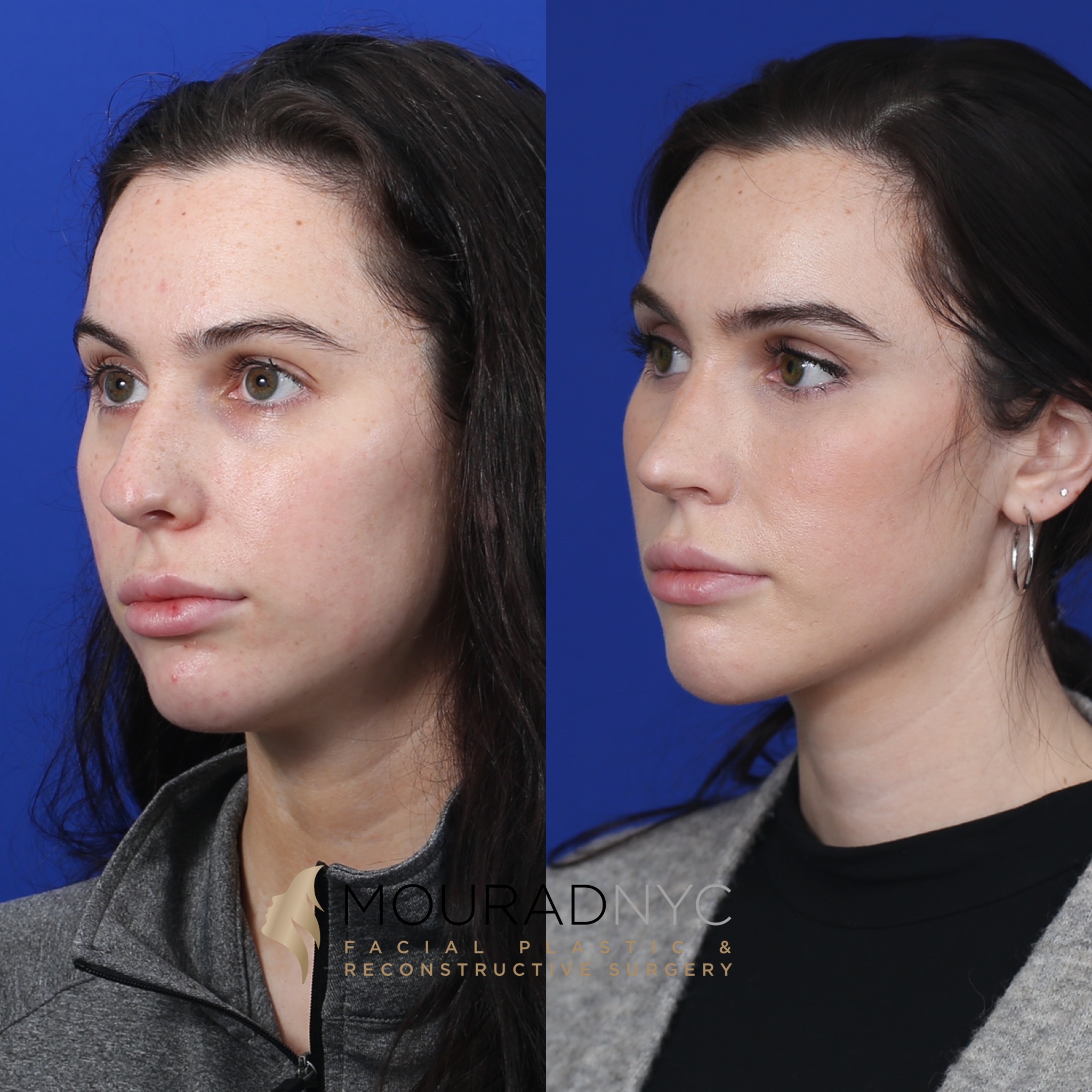 Angle view Before And After Female Rhinoplasty