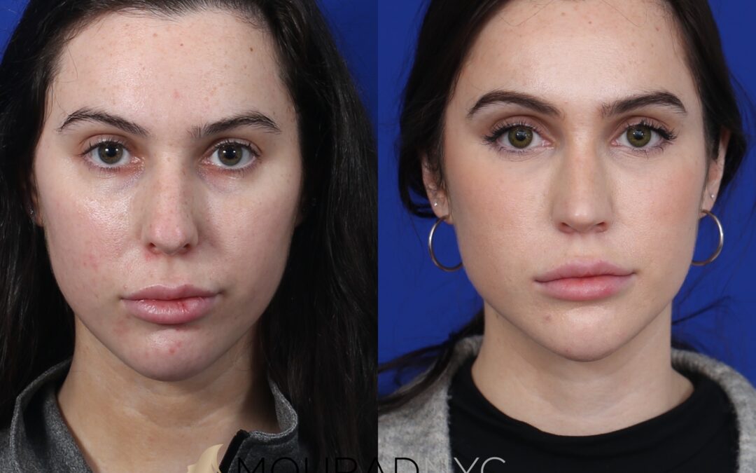 Before And After Female Rhinoplasty
