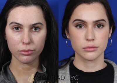 Before And After Female Rhinoplasty