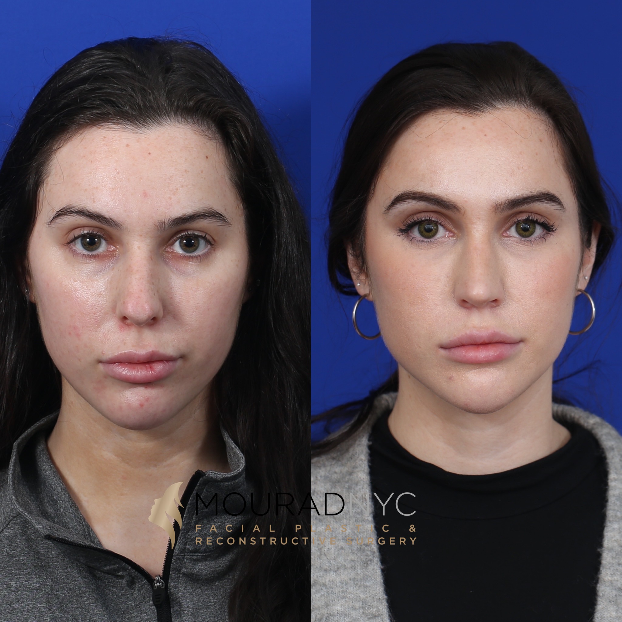 Front view Before And After Female Rhinoplasty