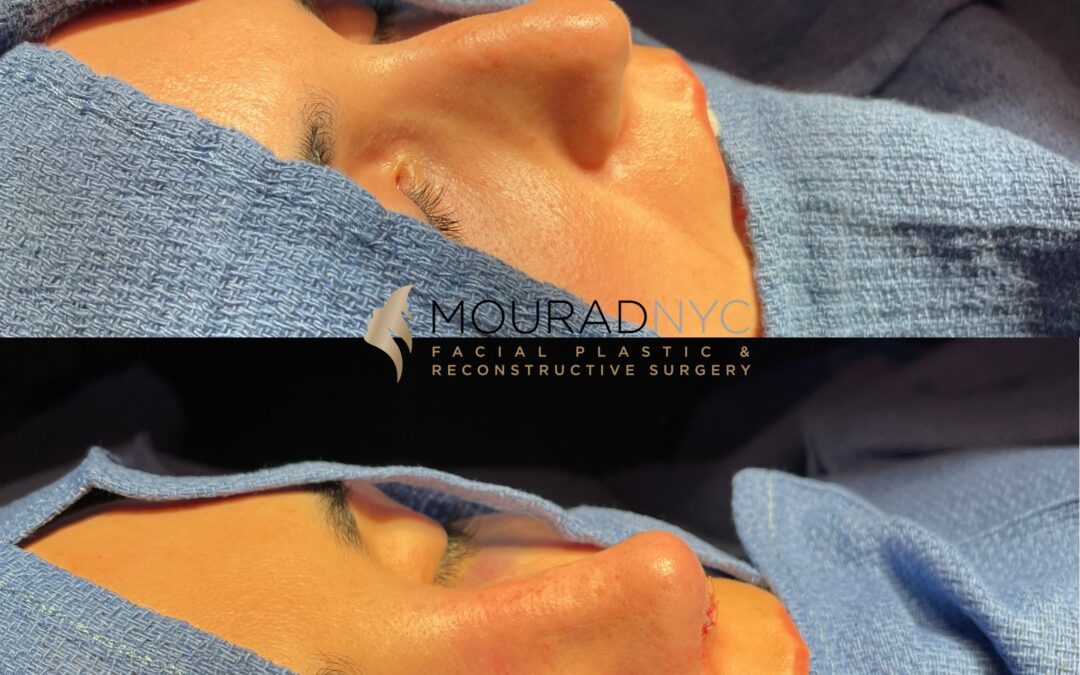 Rhinoplasty Before and After Female