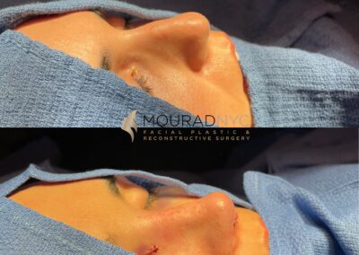 Rhinoplasty Before and After Female