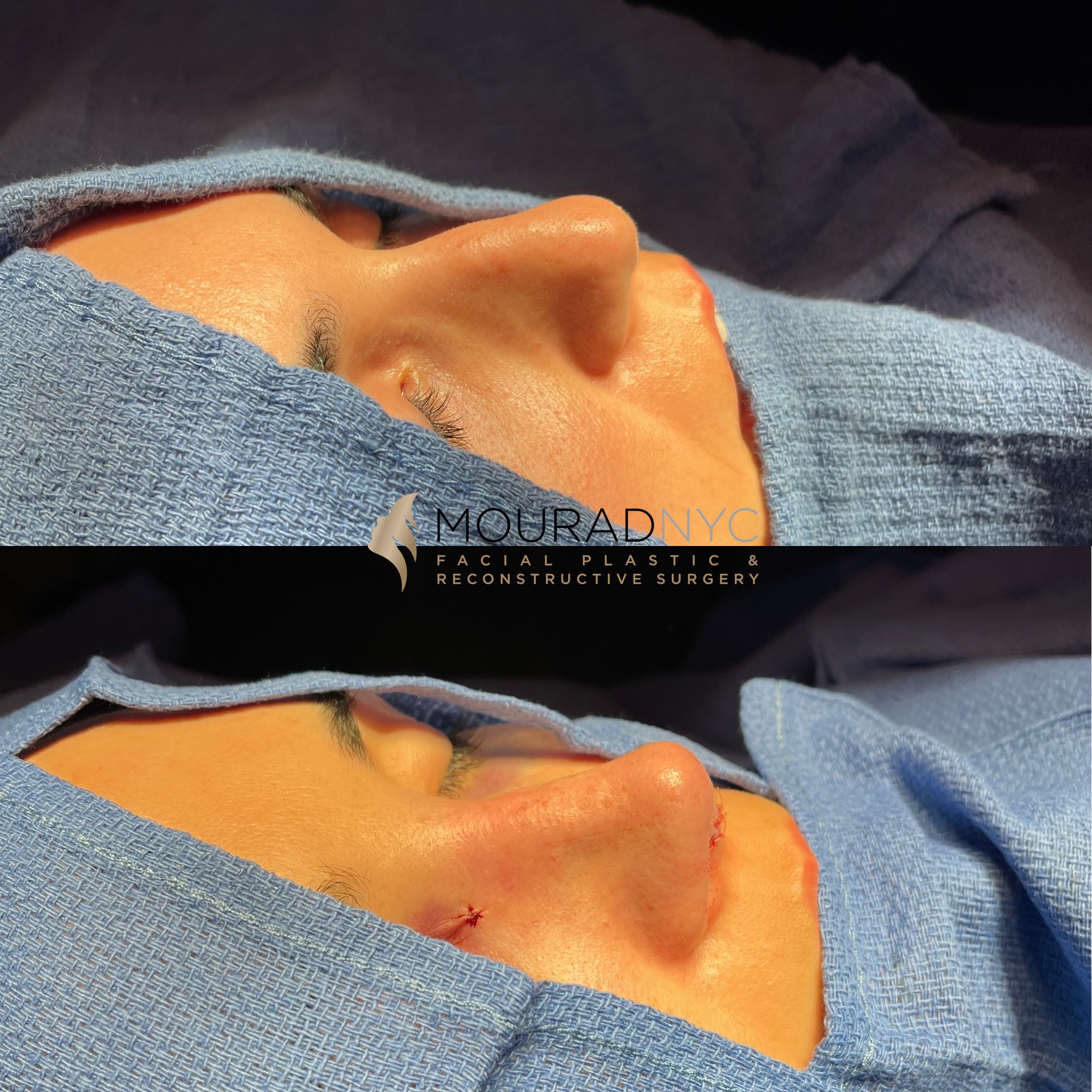 Rhinoplasty Before and After Female