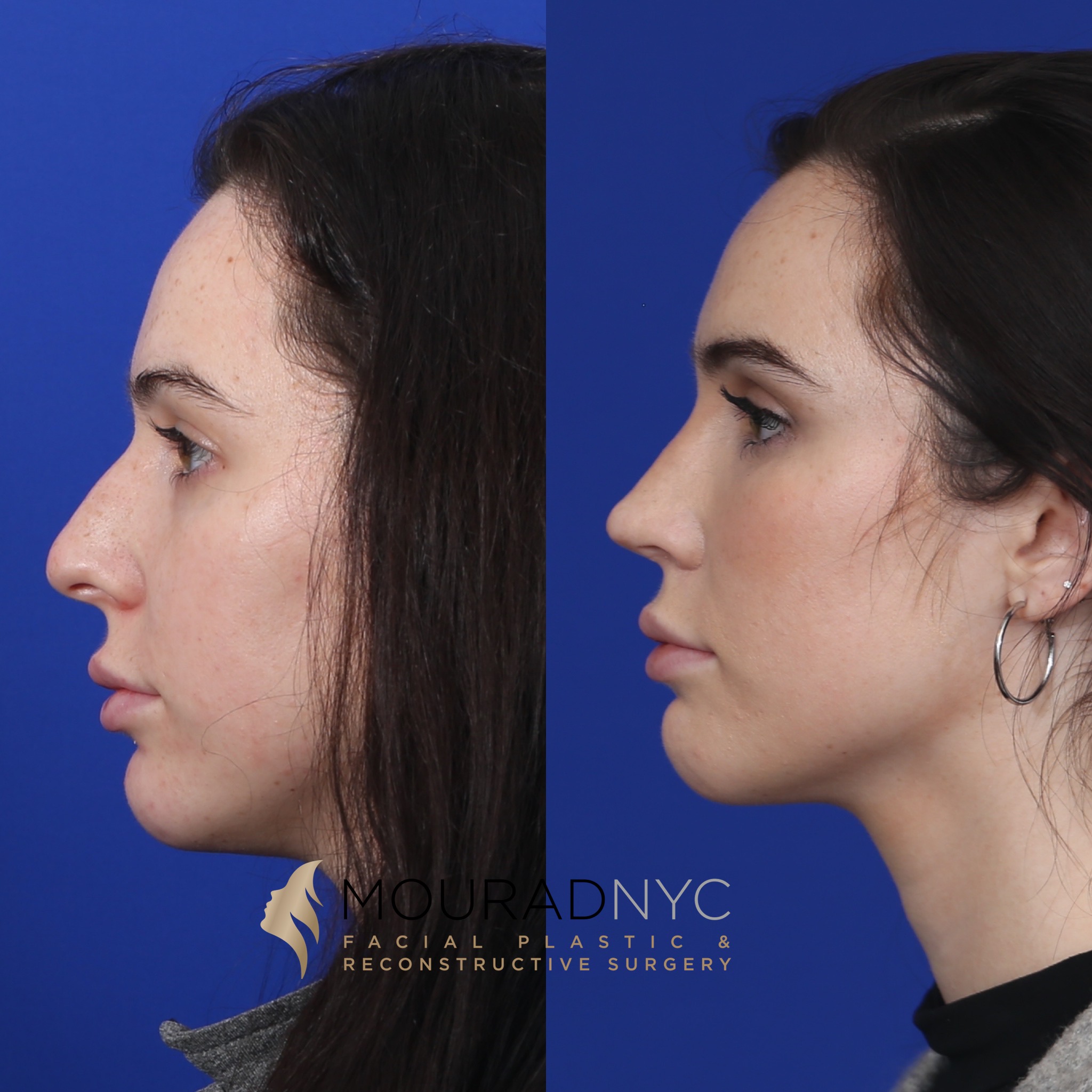 Side view 2 Before And After Female Rhinoplasty