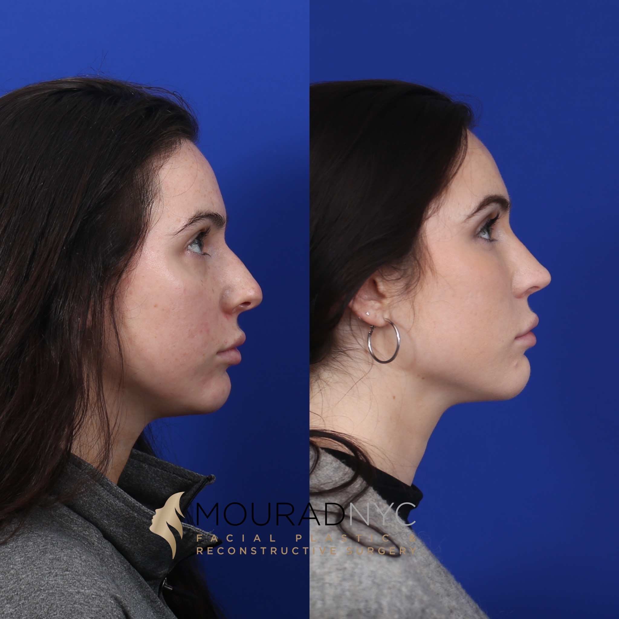 Side view Before And After Female Rhinoplasty