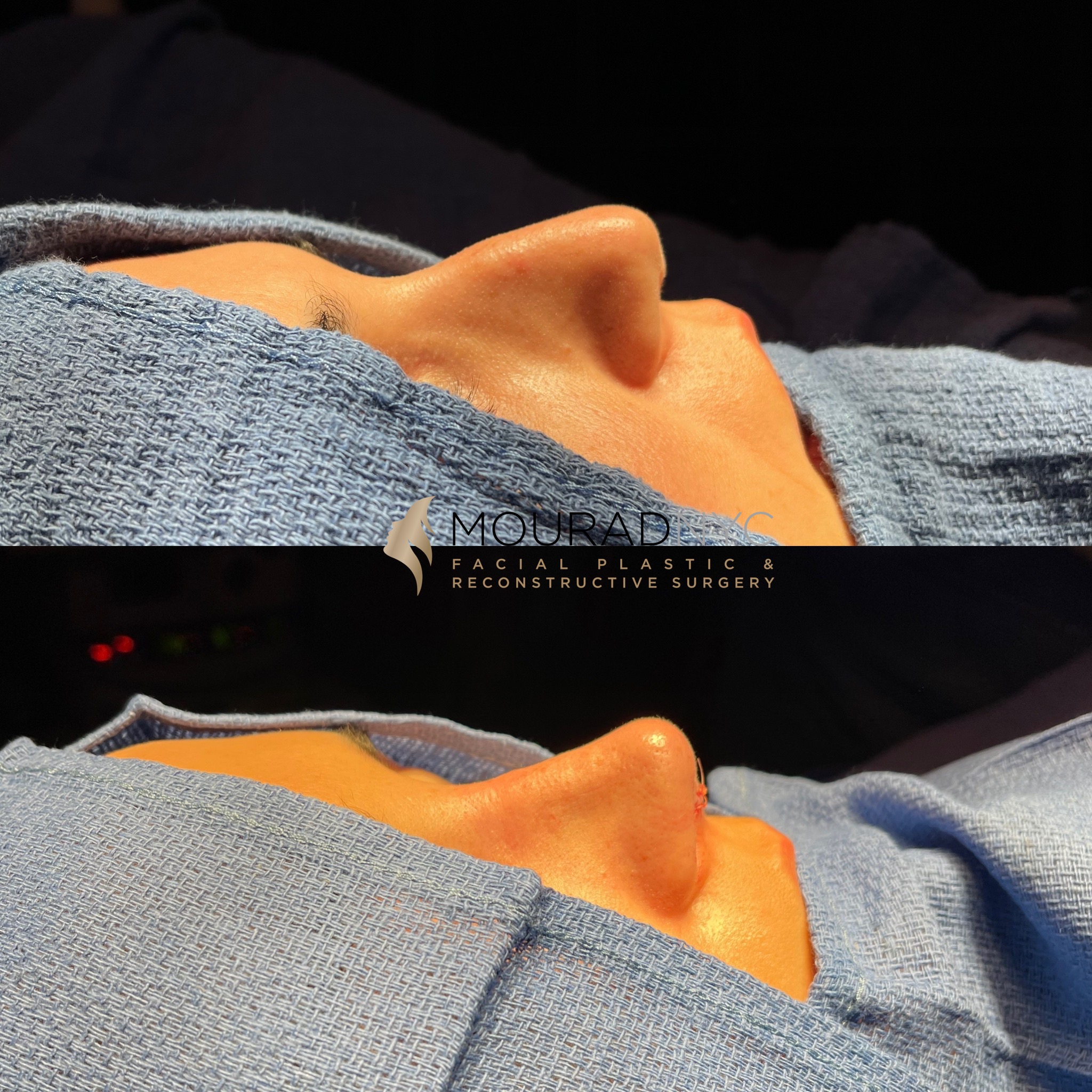 Rhinoplasty Before and After Female