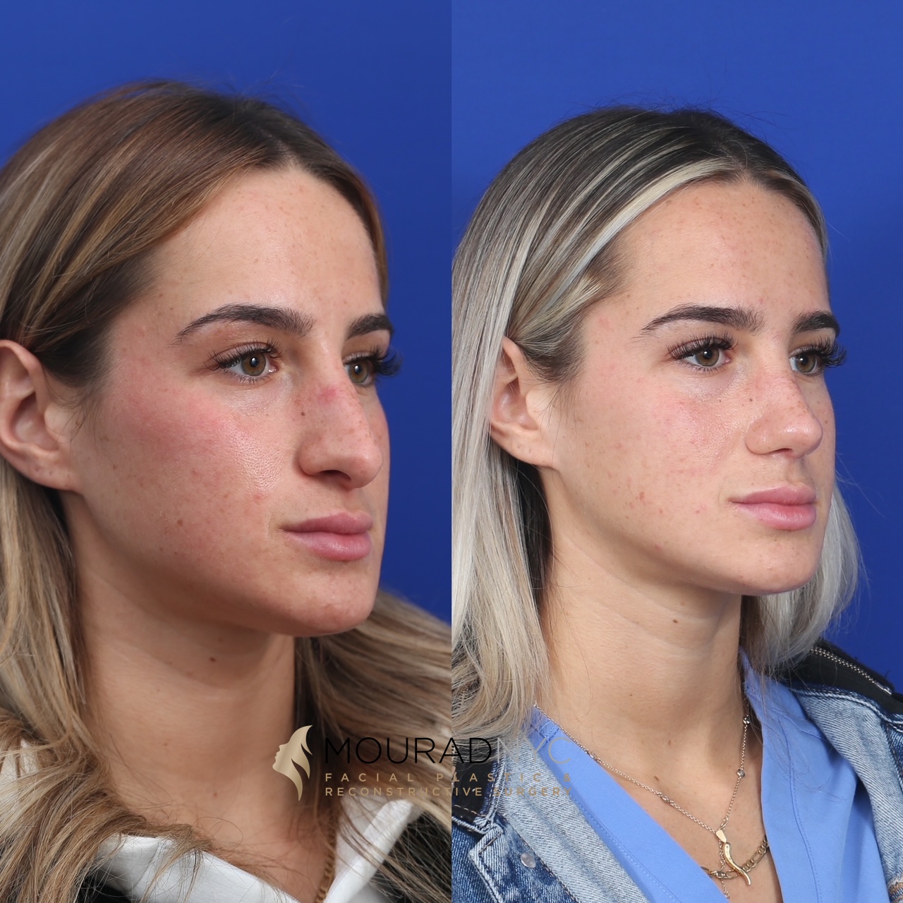 RHINO2 Rhinoplasty Before and After Female