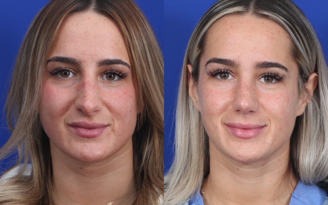 Rhinoplasty Before and After Female