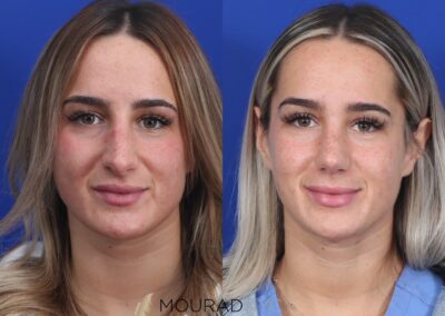 Rhinoplasty Before and After Female