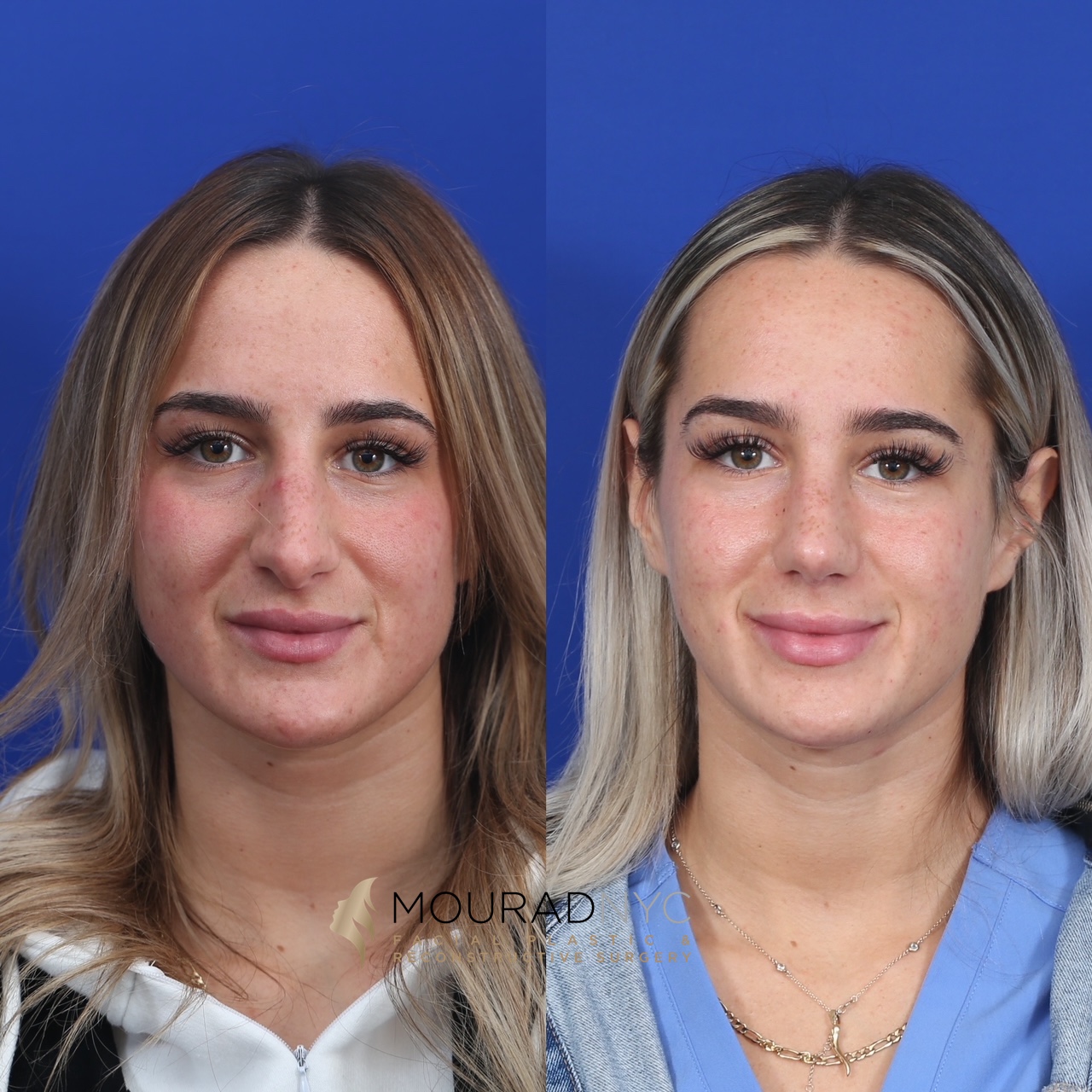 RHINO3 Rhinoplasty Before and After Female