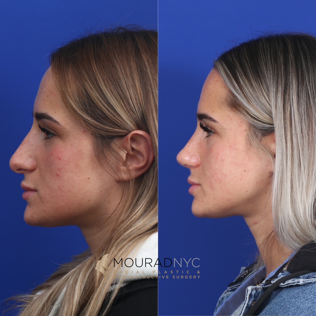 RHINO4 Rhinoplasty Before and After Female