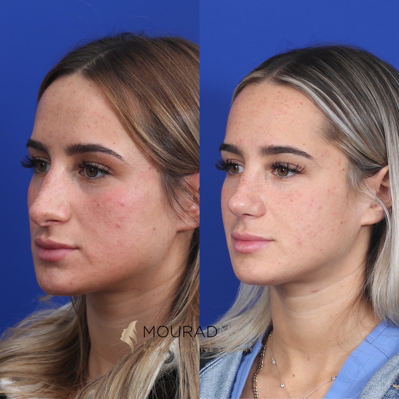 RHINO5 Rhinoplasty Before and After Female