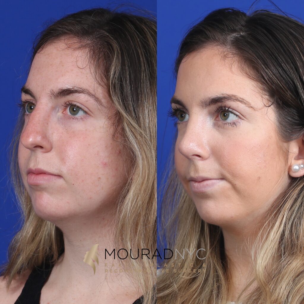 angle-view Open Rhinoplasty Before and After Female