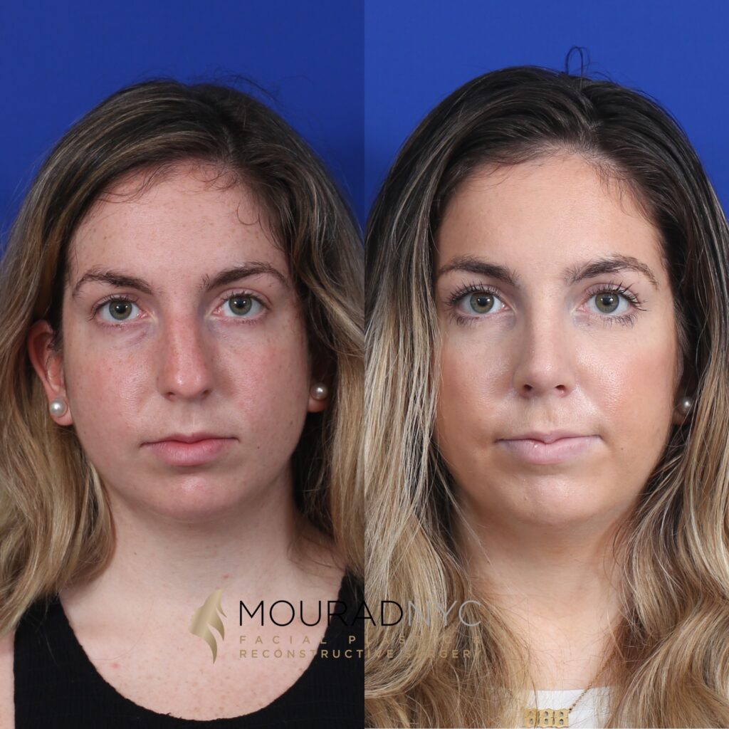 front-view Open Rhinoplasty Before and After Female
