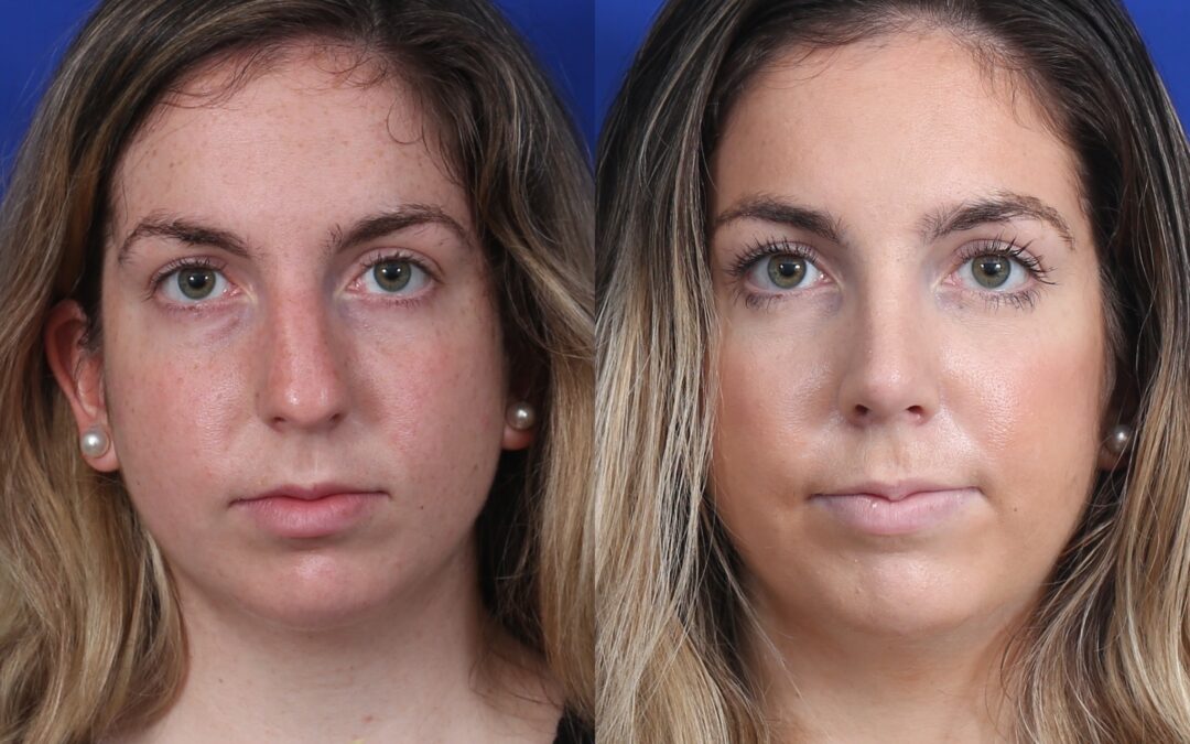 Open Rhinoplasty Before and After Female
