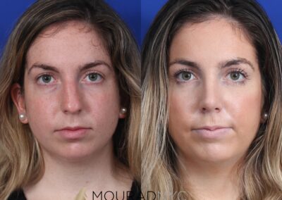 Open Rhinoplasty Before and After Female