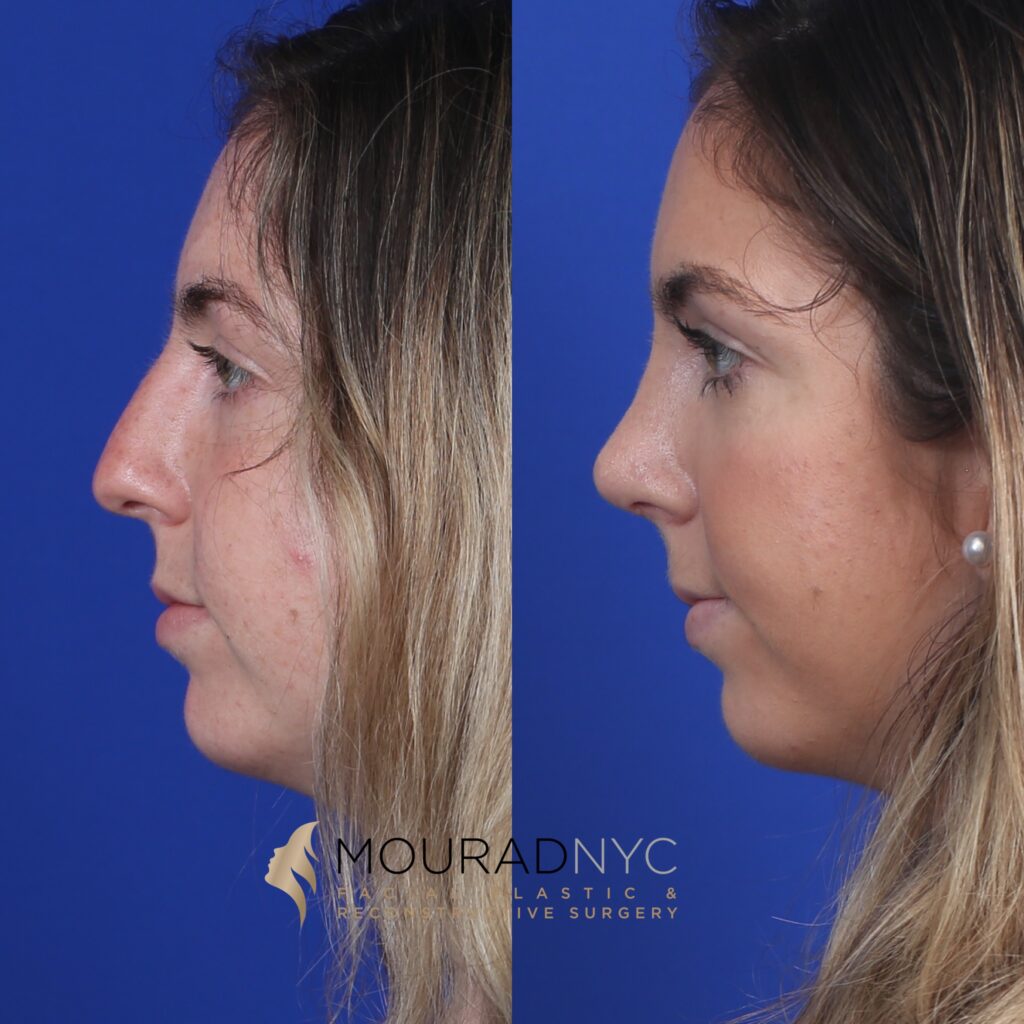 left-side-view Open Rhinoplasty Before and After Female