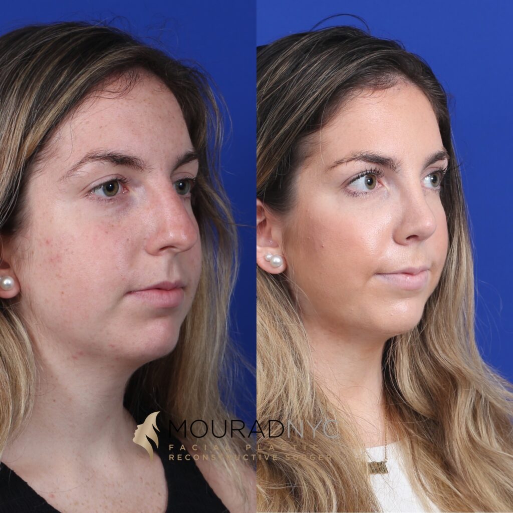 slight-view Open Rhinoplasty Before and After Female