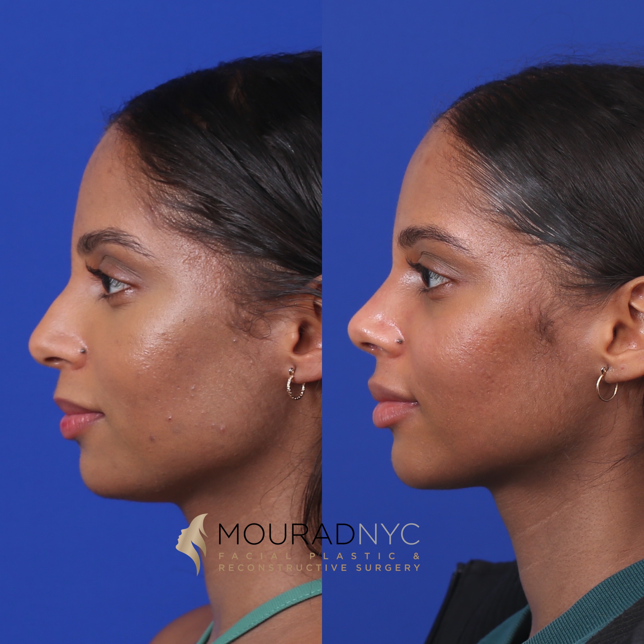 0C171329-467F-4278-8F7F-2B391B50C126 Before and After Female Closed Rhinoplasty Before and After