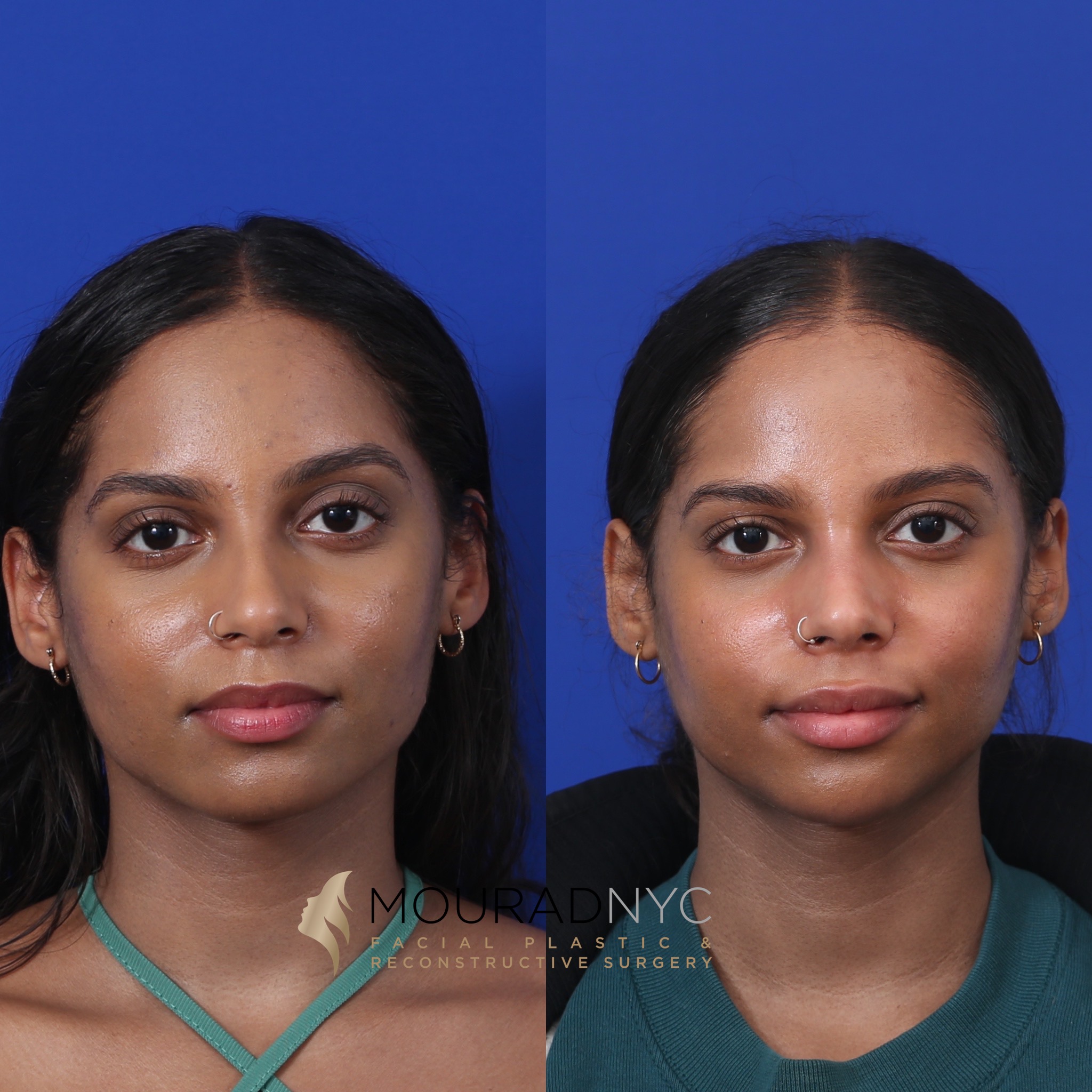 3AE753A2-7D49-484C-B375-54A2EE0907A7 Before and After Female Closed Rhinoplasty Before and After