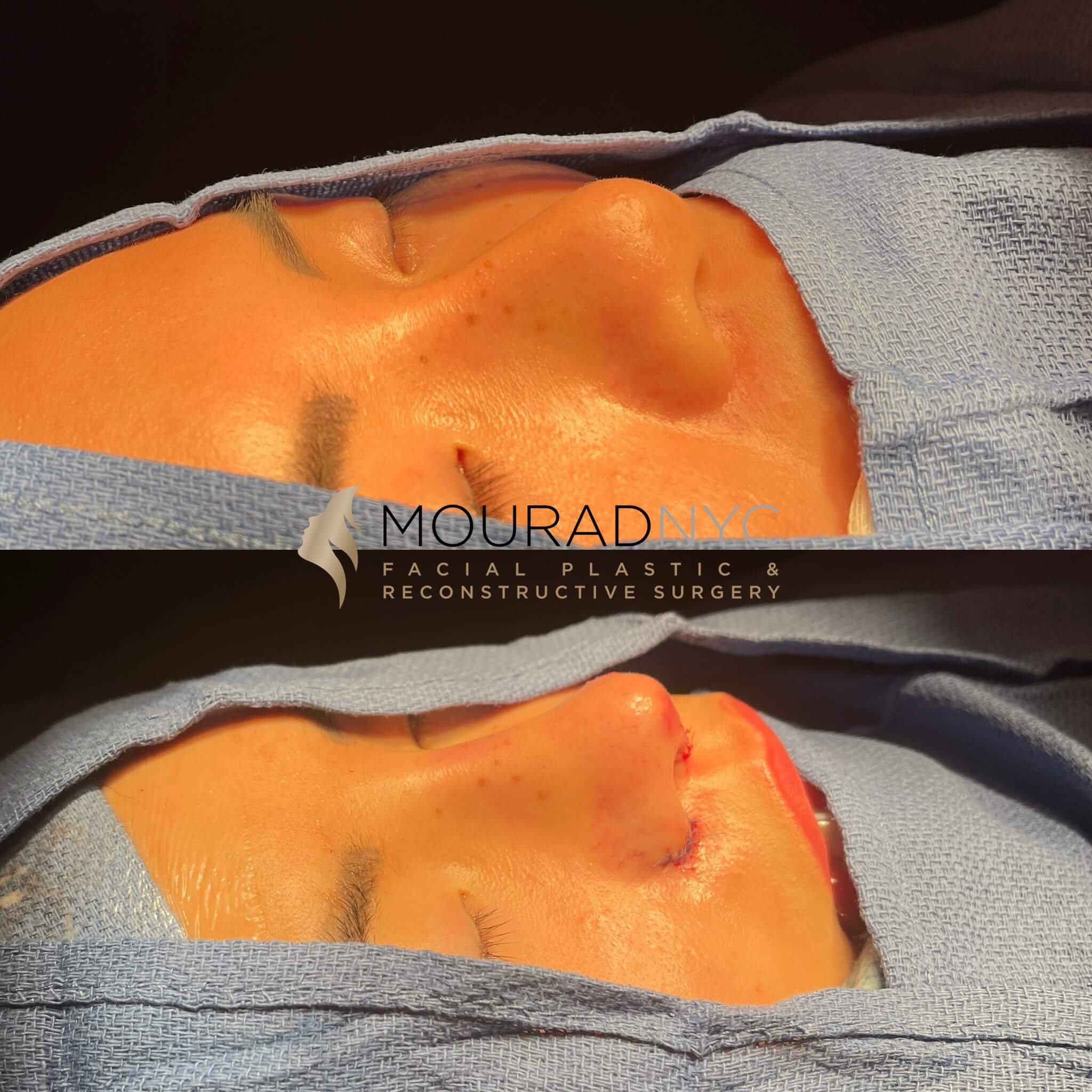5872F671-00D7-41B6-B212-6C80C3127856 Ethnic Rhinoplasty Before and After Female