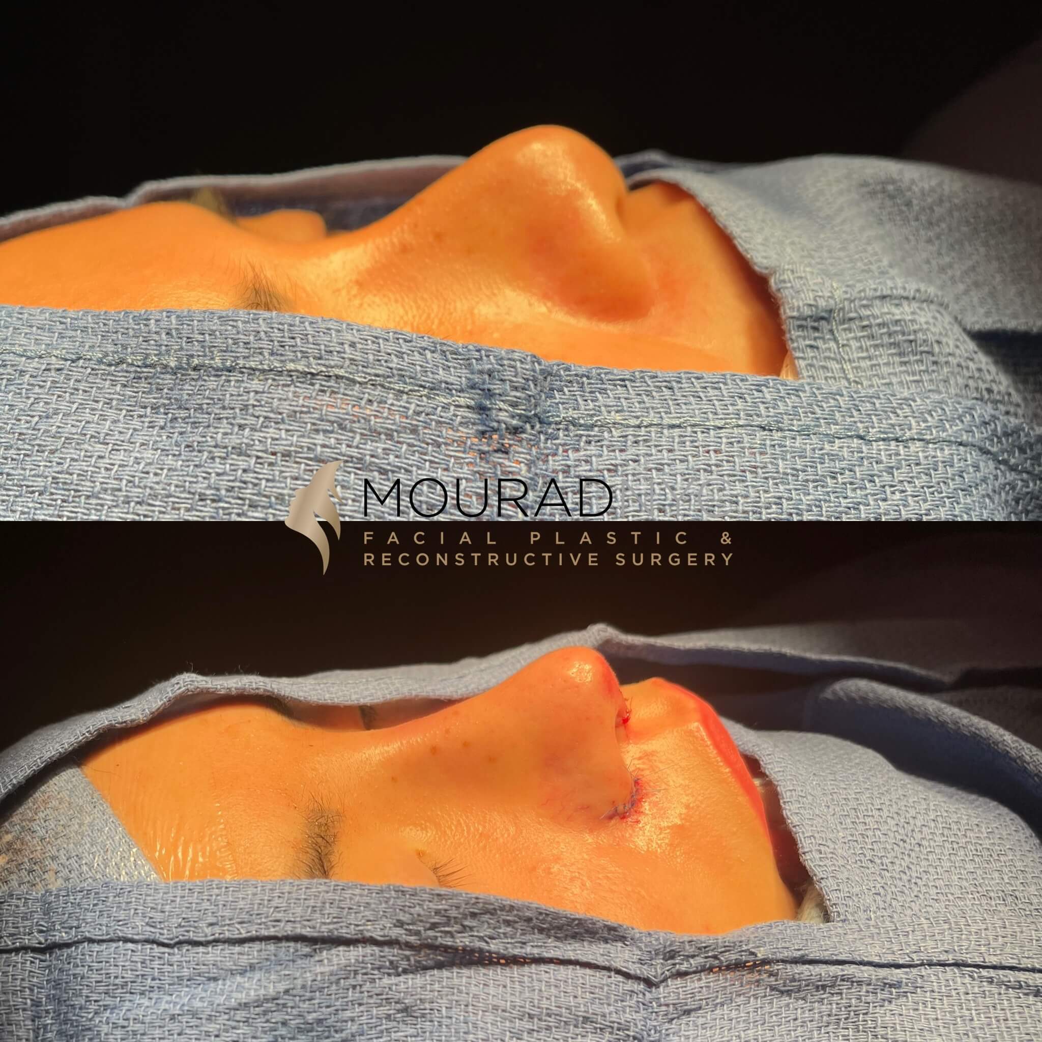 6652DEC2-A78F-4B96-8303-EE604DE8A6F3 Ethnic Rhinoplasty Before and After Female