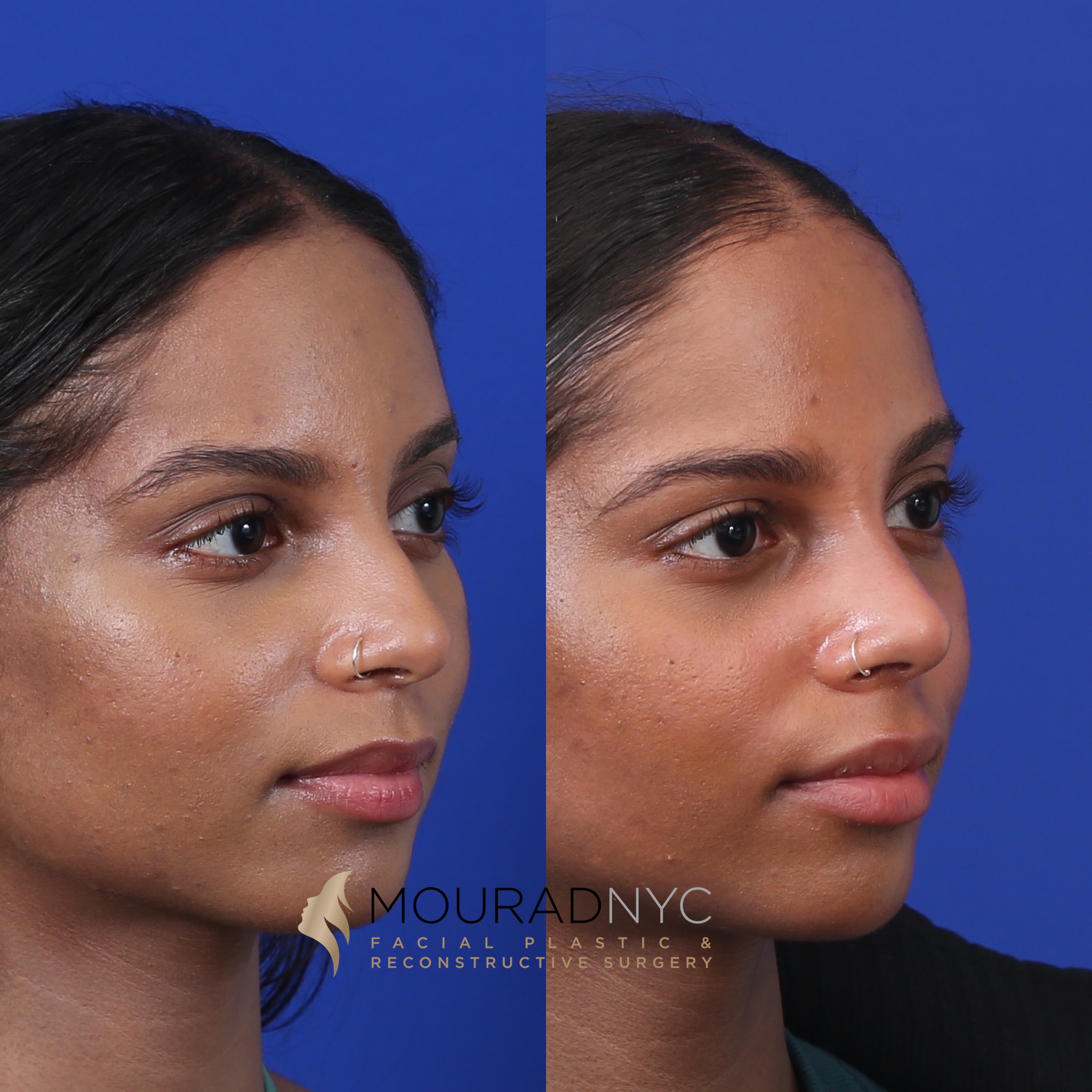 ABBA6C6B-670E-4401-8FA3-DF455336D181 Before and After Female Closed Rhinoplasty Before and After