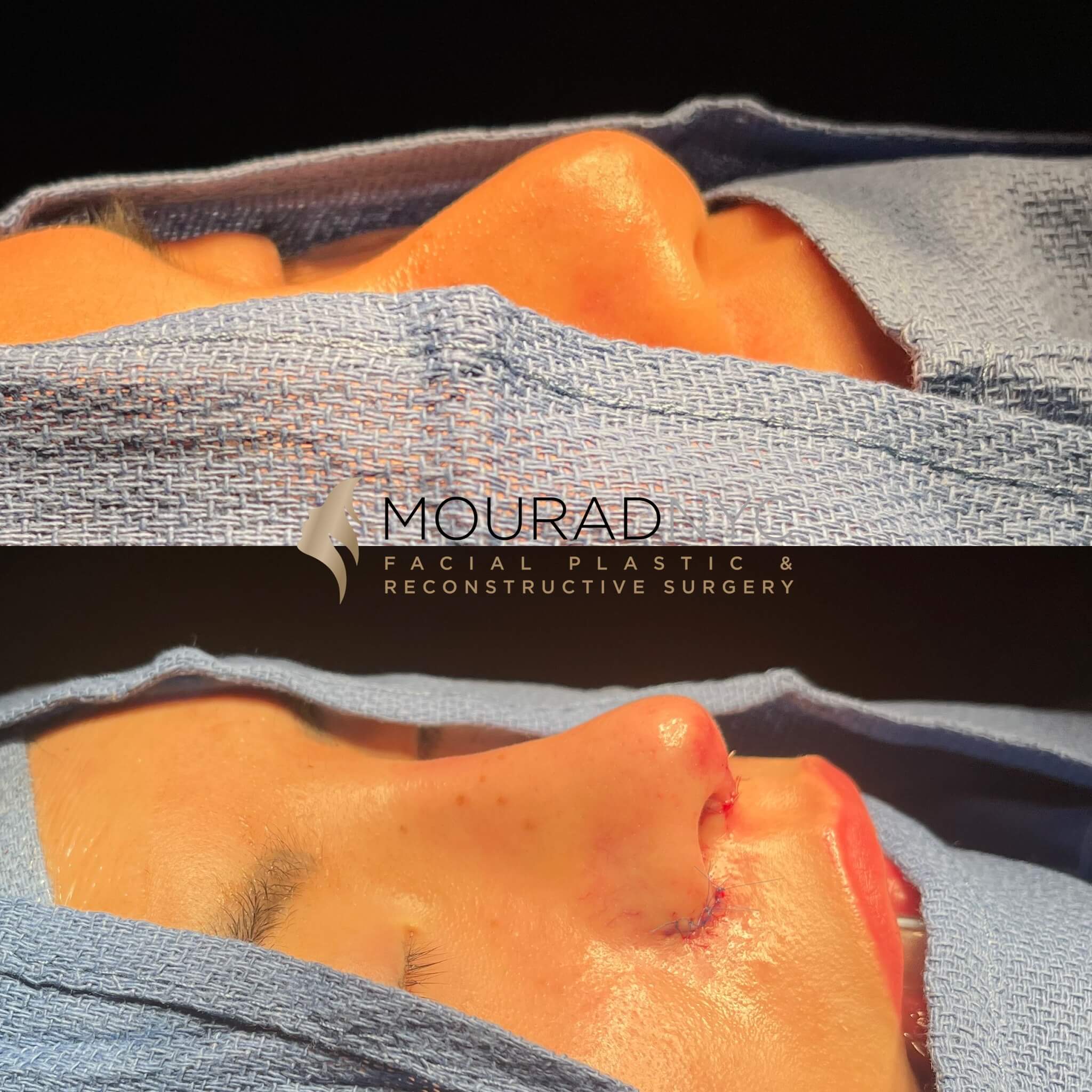 B4E1D631-F641-44D4-BEB1-79E465253F84 Ethnic Rhinoplasty Before and After Female