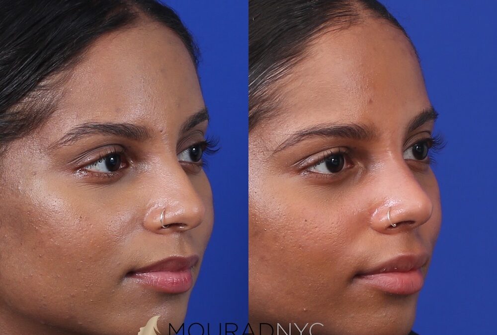 Before and After Female Closed Rhinoplasty Before and After