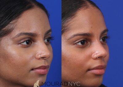 Before and After Female Closed Rhinoplasty Before and After