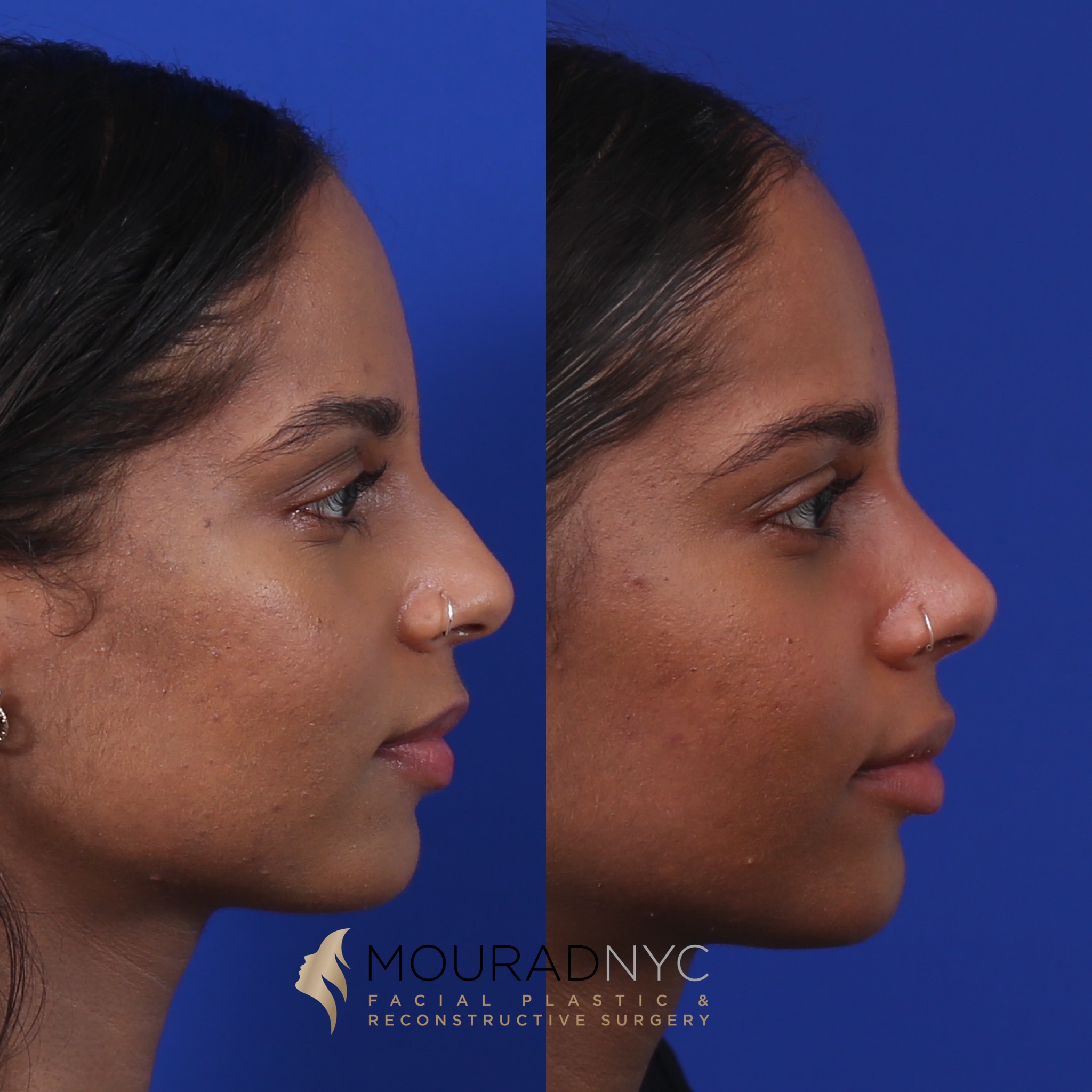 E318EE45-E823-4FD0-8C08-C22E0F1FC3B7 Before and After Female Closed Rhinoplasty Before and After