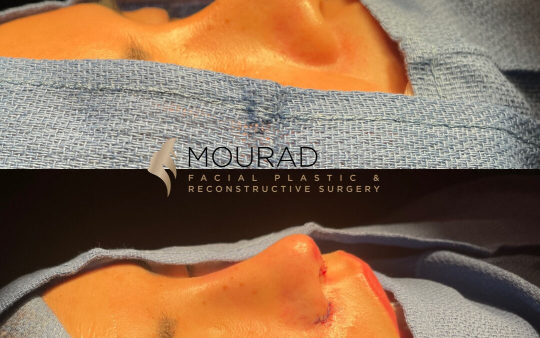 Ethnic Rhinoplasty Before and After Female