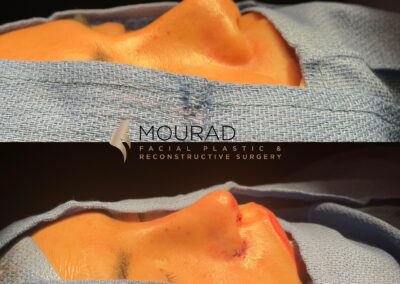 Ethnic Rhinoplasty Before and After Female