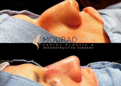 Before and After Male Rhinoplasy
