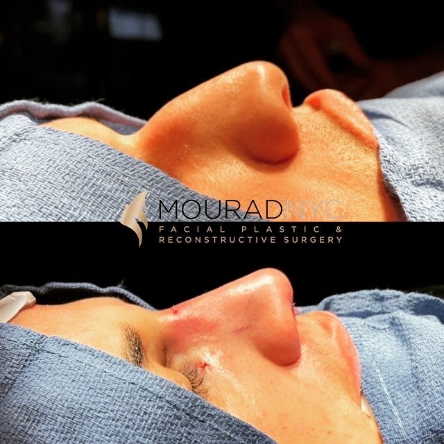 IMG_5507 Before and After Male Rhinoplasy