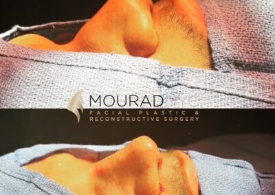Rhinoplasty & Male Rhinoplasty & Ethnic Rhinoplasty