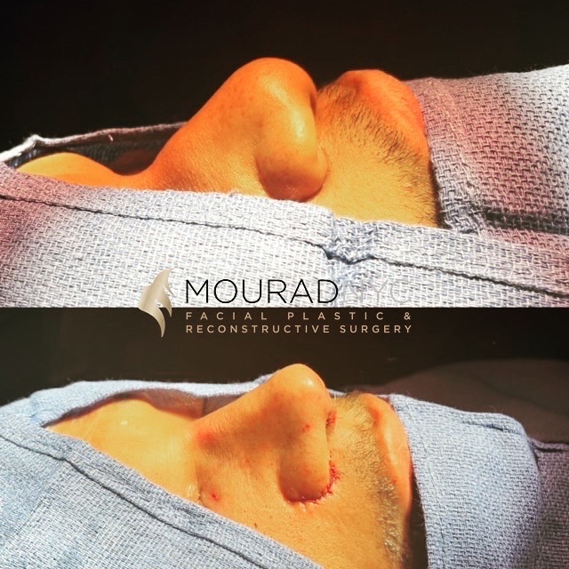 Rhinoplasty & Male Rhinoplasty & Ethnic Rhinoplasty