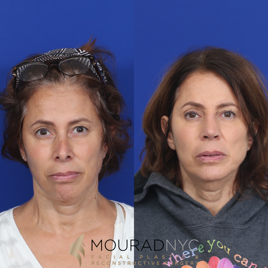 1 Rhinoplasty & Female Rhinoplasty & Septal Perforation