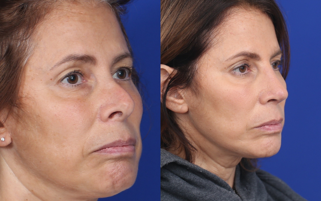Rhinoplasty & Female Rhinoplasty & Septal Perforation