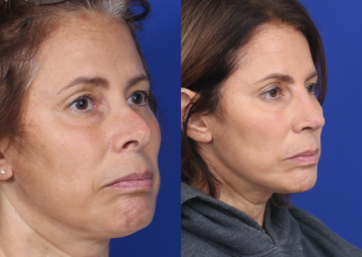 Rhinoplasty & Female Rhinoplasty & Septal Perforation