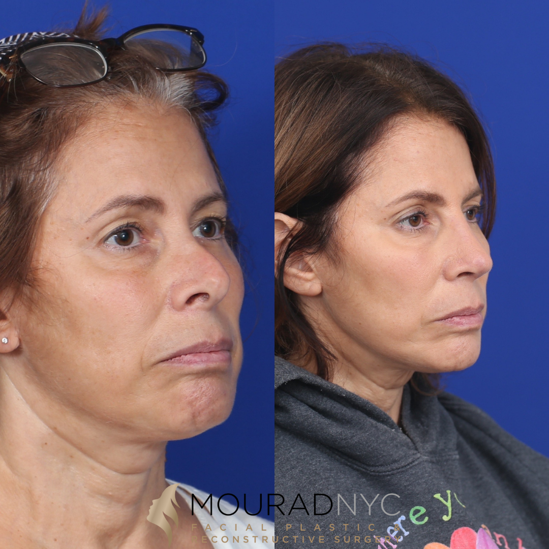 2 Rhinoplasty & Female Rhinoplasty & Septal Perforation