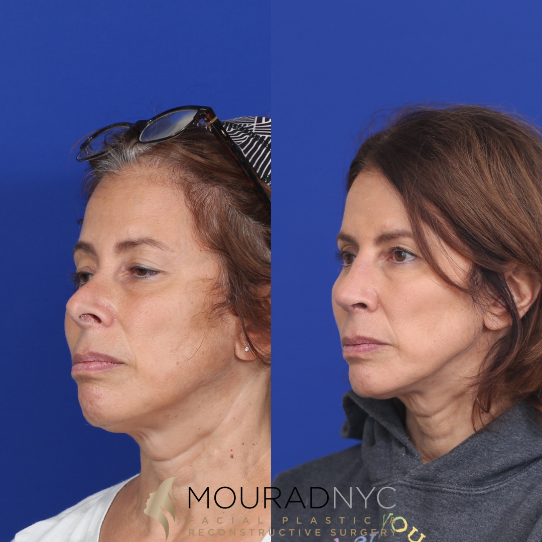 3 Rhinoplasty & Female Rhinoplasty & Septal Perforation