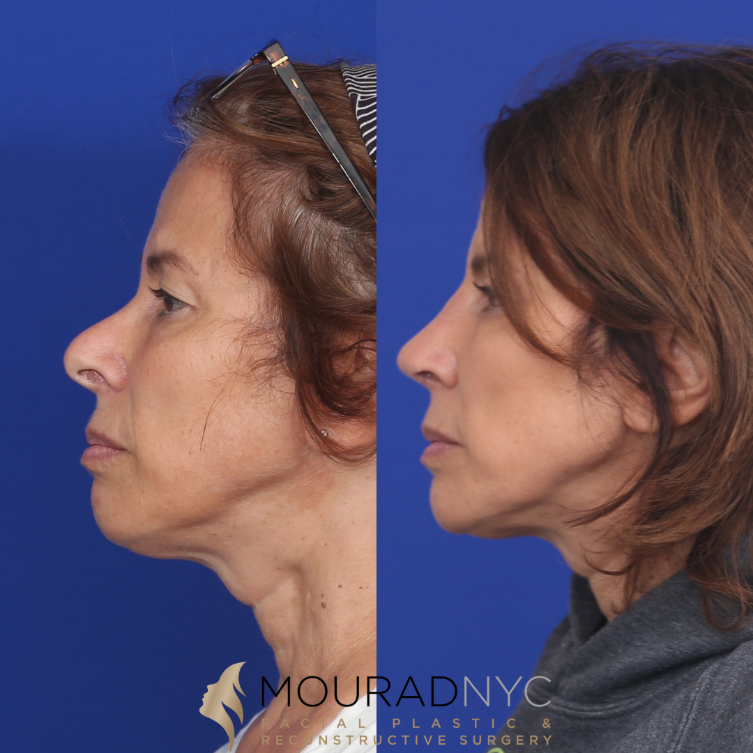 4 Rhinoplasty & Female Rhinoplasty & Septal Perforation