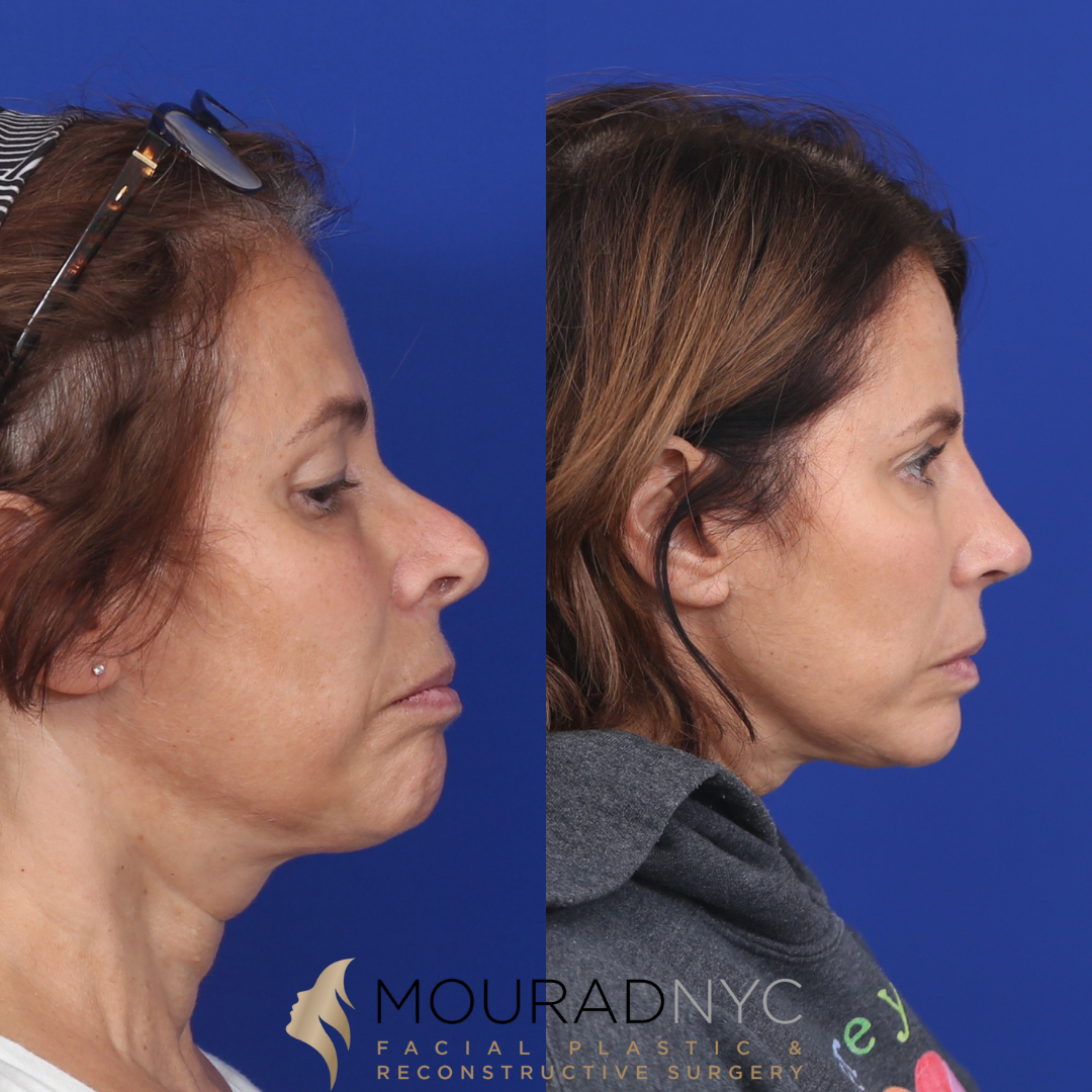 5 Rhinoplasty & Female Rhinoplasty & Septal Perforation