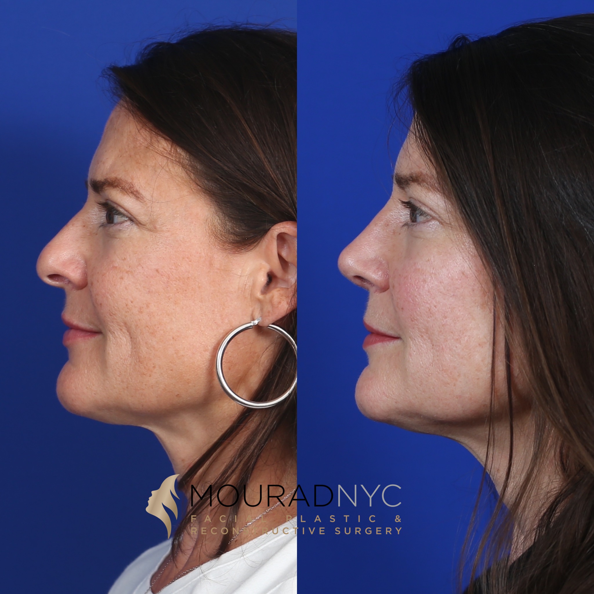 MC1 Rhinoplasty & Female Rhinoplasty