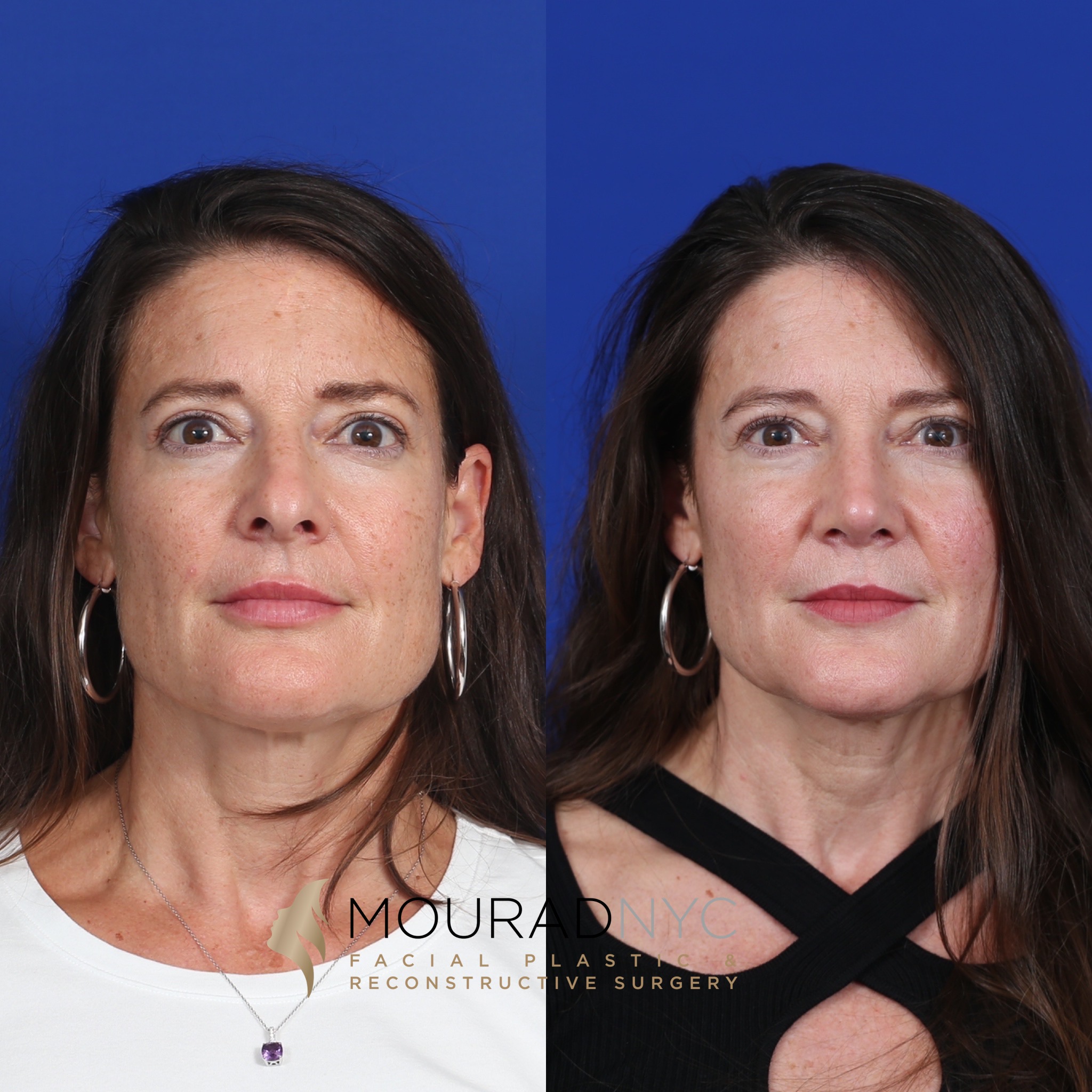 MC2 Rhinoplasty & Female Rhinoplasty