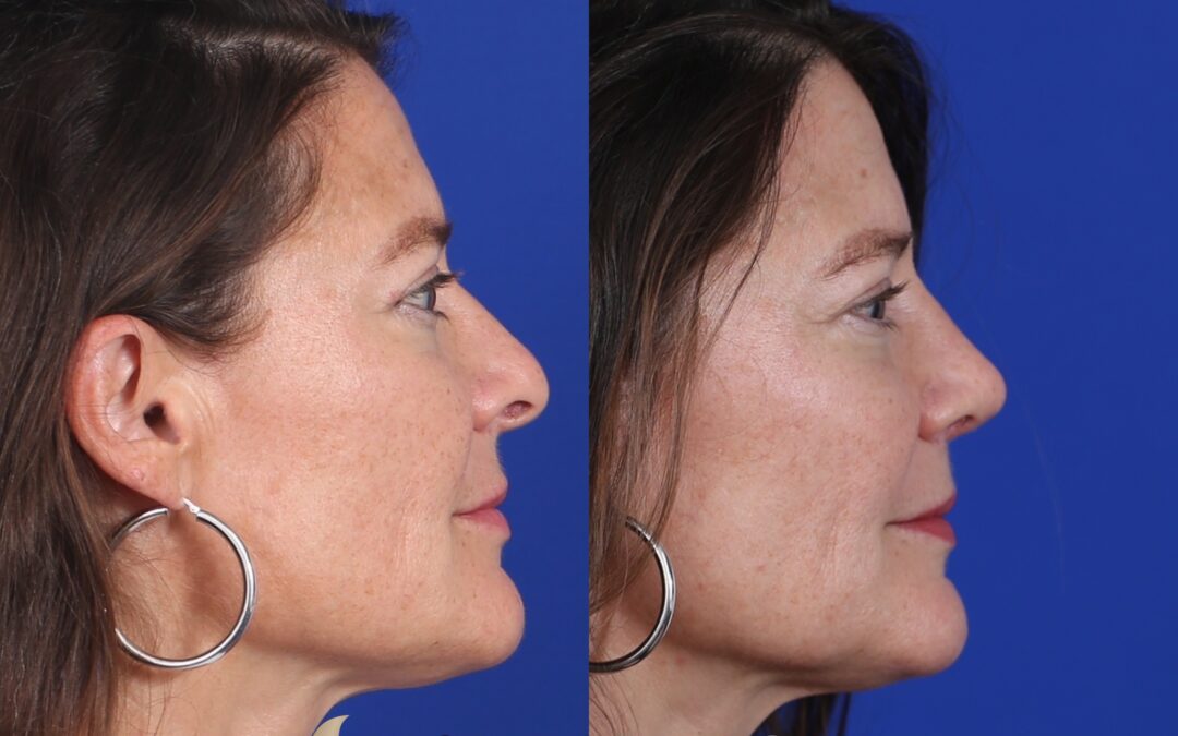 Rhinoplasty & Female Rhinoplasty